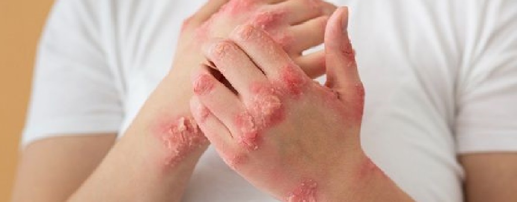 La sífilis se previene